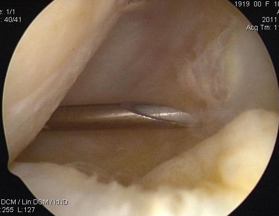 Knee Posterolateral Portal